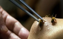 Bị ong đốt trên 100 vết vẫn sống