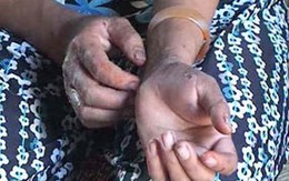 Bệnh ngứa lây nhanh ở Quảng Ngãi chỉ là bệnh ghẻ ruồi