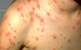 Khẩn cấp phòng tránh dịch bệnh Rubella