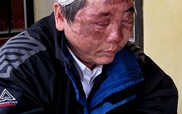 Mâu thuẫn với mẹ, hắt axít vào con