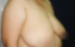 Thiếu nữ vẹo cột sống vì ngực "khủng"