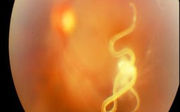 Ăn ốc sống, bị giun chui lên mắt 