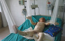 Nhảy xuống hố vôi cứu con 2 tuổi rưỡi