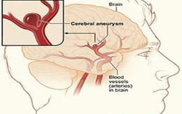 Hướng mới trong điều trị phình mạch não