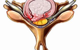 Thoát vị đĩa đệm và những hậu quả khó lường