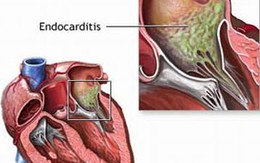Cứu bệnh nhân loạn nhịp tim đột ngột