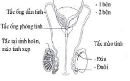 Nguyên nhân gây tắc ống phóng tinh