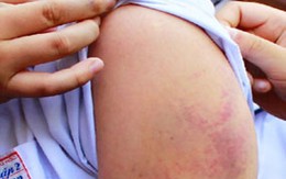 Học sinh lớp 2 bị cô giáo đánh bầm tím tay