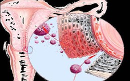 Sùi mào gà và những biến chứng
