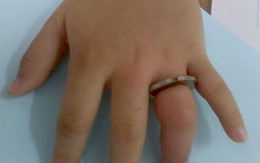 Bé gái suýt mất ngón tay vì đeo nhẫn