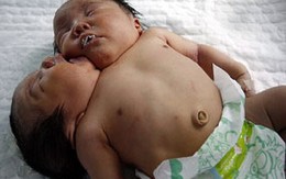 Kỳ lạ bé gái 2 đầu