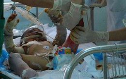 Bé bị cha đốt phải đắp da lợn lên vết thương