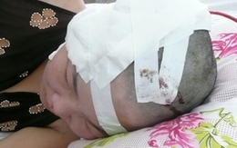 "Thấy ghét", đánh hội đồng vỡ đầu cô gái 19 tuổi