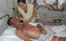Mù mắt, bỏng nặng vì dùng... bếp cồn