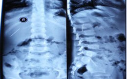 3 cây kim khâu trong bụng bé 5 tuổi