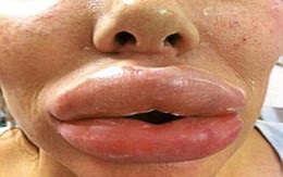 Môi biến dạng vì chất độn thẩm mỹ