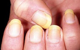 Nhìn móng tay đoán được bệnh tật
