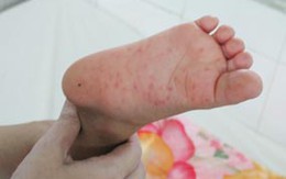 Virus gây bệnh tay chân miệng xuất hiện tuýp mới tử vong cao