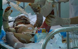 Bé 3 tuổi bị bố đốt phải ghép da lại