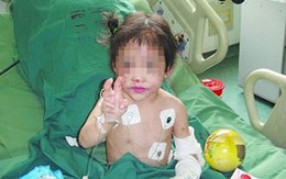 Mẹ đánh gãy xương sườn con 6 tuổi