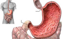 Dấu hiệu rối loạn chức năng dạ dày