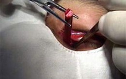Cách xử trí dị vật trong cơ thể