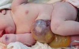 Cứu bé sơ sinh thoát vị thành bụng