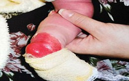 Nữ hộ sinh ngâm chân bé sơ sinh vào nước nóng