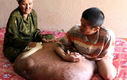Người đàn ông có khối u nặng 80kg
