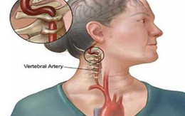 5 yếu tố giúp ngừa tai biến lại