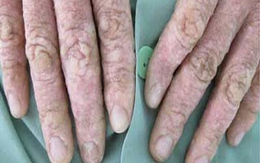 Nhiễm độc vì uống thạch tín chữa vảy nến