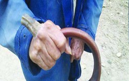 Kỳ lạ ông lão mọc sừng trên tay 
