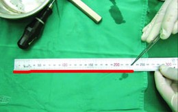 Sâu dài 1 mét sống trong não người 