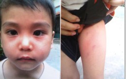 Cháu bé 5 tuổi bị dì ruột đánh đập