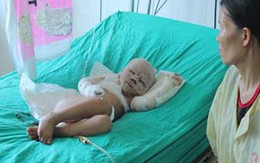 Ngã vào nồi rượu, bé gái bỏng nặng