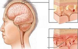 Người lớn cũng mắc viêm màng não mủ 