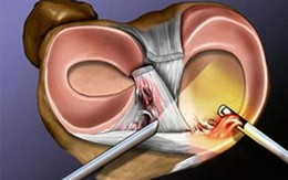 Mổ nội soi khớp có thể gây ra nhiều biến chứng