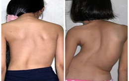 BV Việt Đức: Hỗ trợ tiền áo chỉnh cột sống
