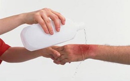 Cách sơ cứu bỏng lửa, nước sôi