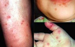 TP HCM: Đối mặt cùng lúc với 3 loại dịch bệnh