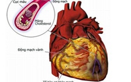 Bệnh tim do tăng huyết áp - Một thảm họa thầm lặng