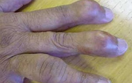 Chế độ ăn uống cho người bệnh gout