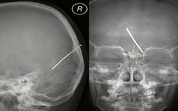Bé 7 tuổi bị đinh đâm xuyên hộp sọ
