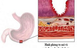 Tiểu đường làm tăng nguy cơ ung thư đại tràng