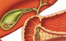4 cách đơn giản phòng bệnh sỏi mật