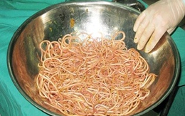 Bé 34 tháng chứa 0,5kg giun trong bụng
