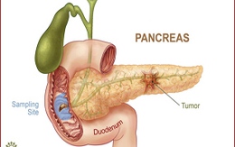 Ai có nguy cơ mắc ung thư tuyến tụy?