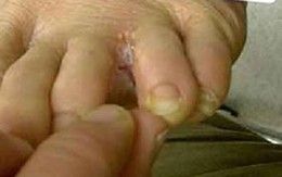 Trị nước "ăn chân"
