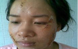 Vợ trẻ “tàn thân“ vì chồng bạo hành