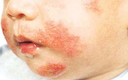 Trẻ viêm da cơ địa có chữa khỏi?